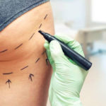 drainage chirurgie esthétique